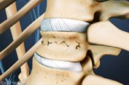 kyphoplasty-for-compression-fracture